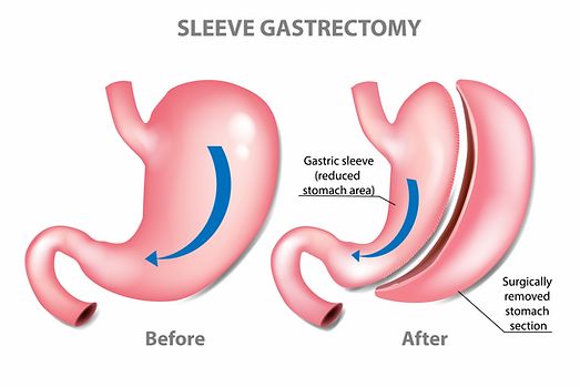 successful sleeve gastrectomy