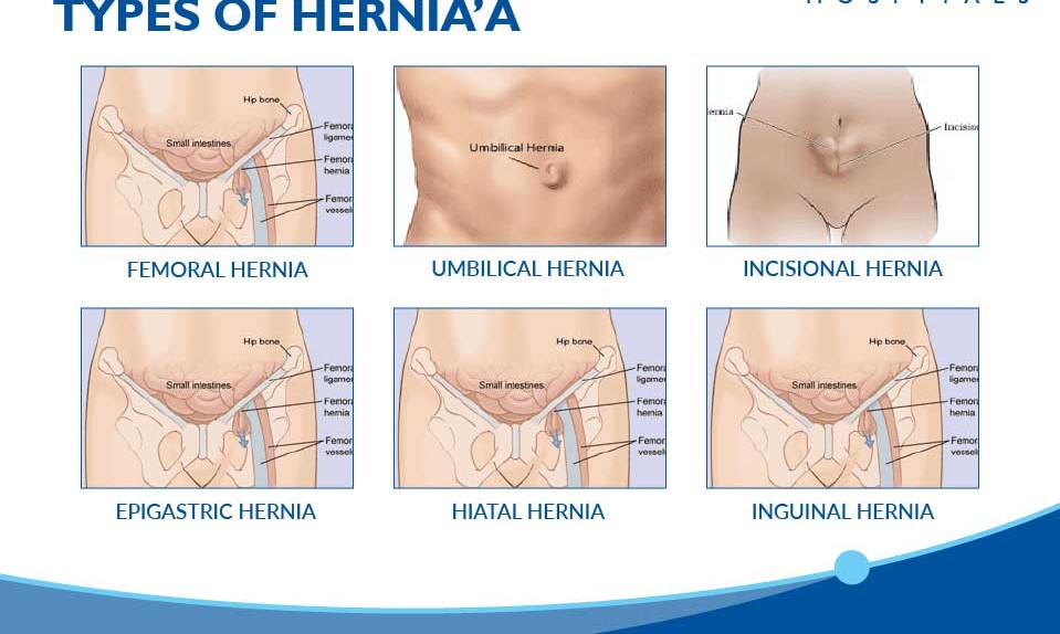 guidance for inguinal hernia repair
