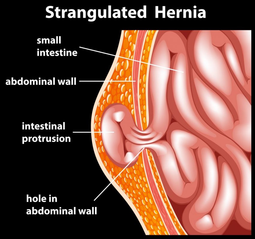 guidance for inguinal hernia repair