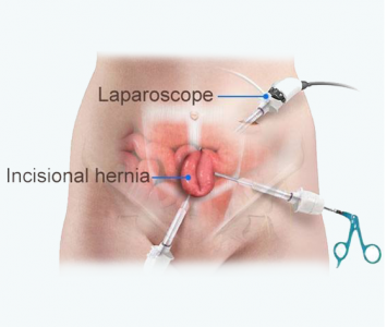Hernia Repair in Pakistan