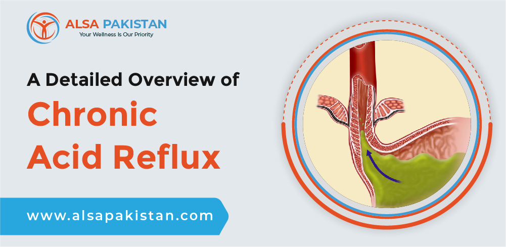 Overview of Chronic Acid Reflux