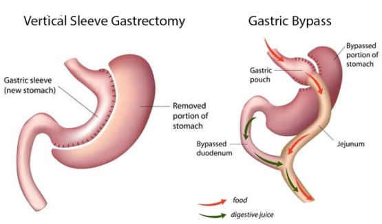 sleeve gastrectomy after gastric bypass