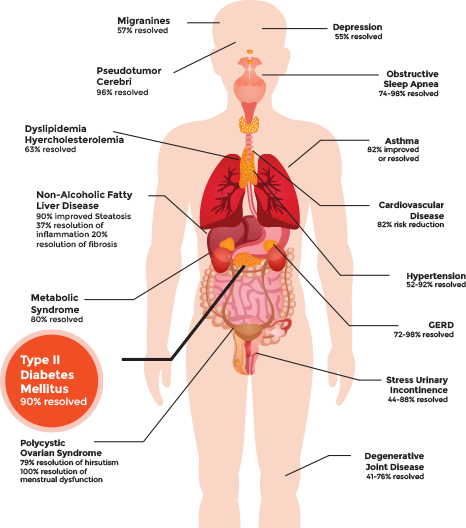 Bariatric surgery