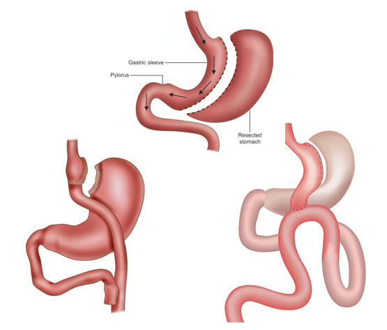 Types of Bariatric surgeries