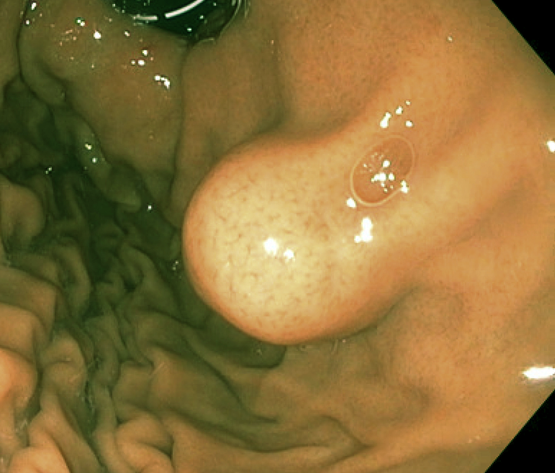Gastrointestinal stromal tumor