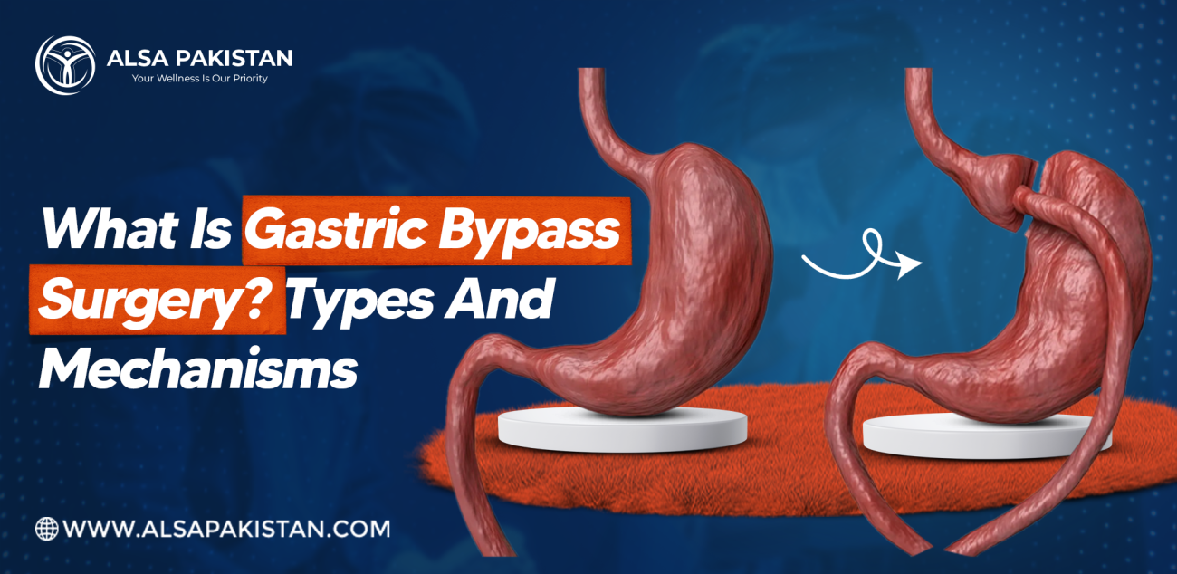 Gastric Bypass SURGERY