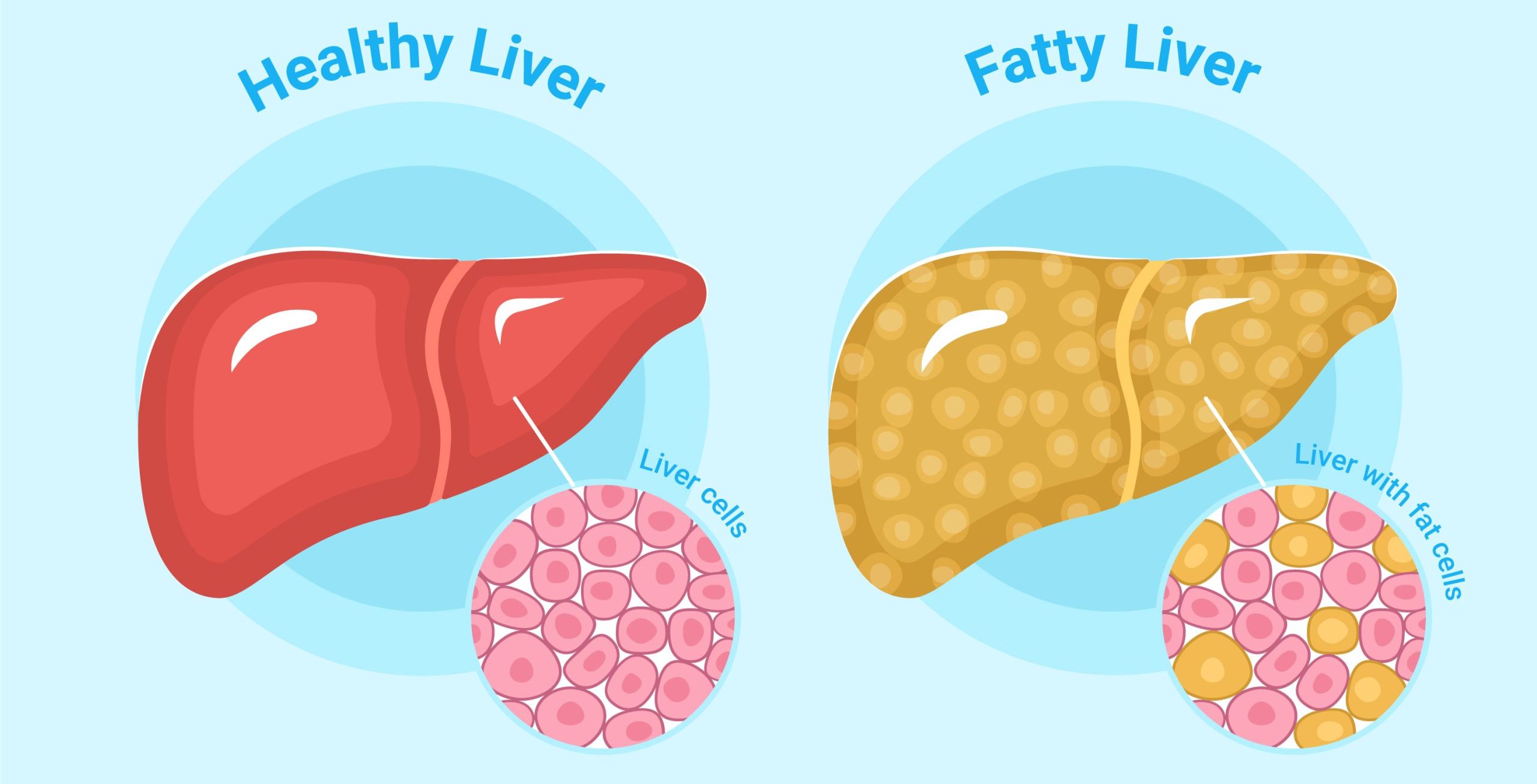 Fatty liver