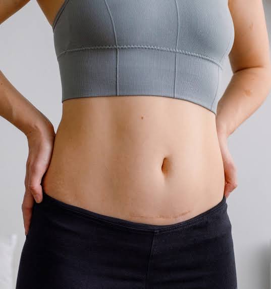 belly fat after C-section
